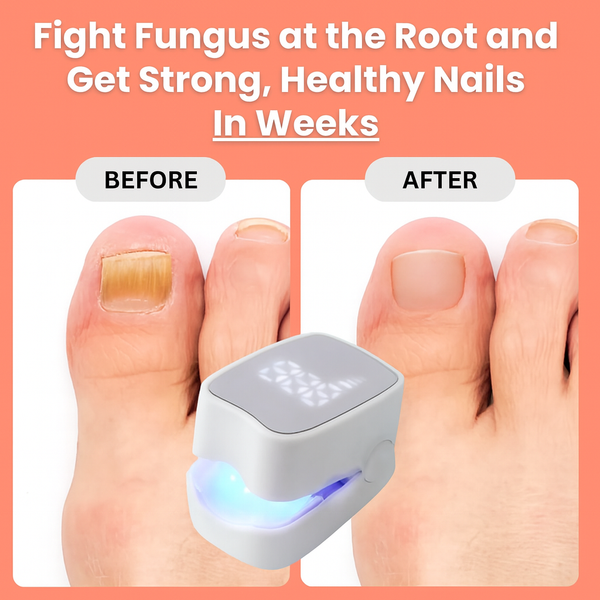 VivaNails™ – Nail Fungus Laser